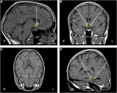 Deep Brain Stimulation of the Nucleus Accumbens in Severe Enduring Anorexia Nervosa: A Pilot Study